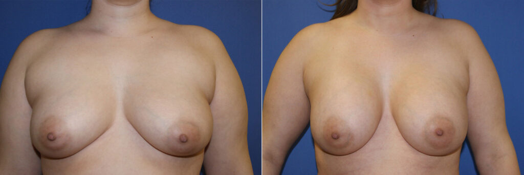 Breast Augmentation Before & After Photo. Breast Augmentation performed at Chau Plastic Surgery in Metro Detroit, MI.