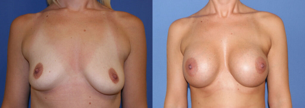 Breast Augmentation Before & After Photo. Breast Augmentation performed at Chau Plastic Surgery in Metro Detroit, MI.