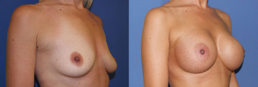Breast Augmentation Before & After Photo. Breast Augmentation performed at Chau Plastic Surgery in Metro Detroit, MI.