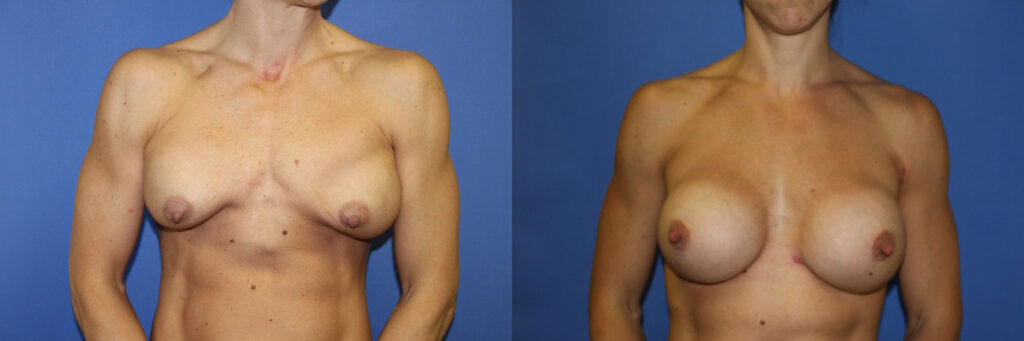 Breast Augmentation Before & After Photo. Breast Augmentation performed at Chau Plastic Surgery in Metro Detroit, MI.