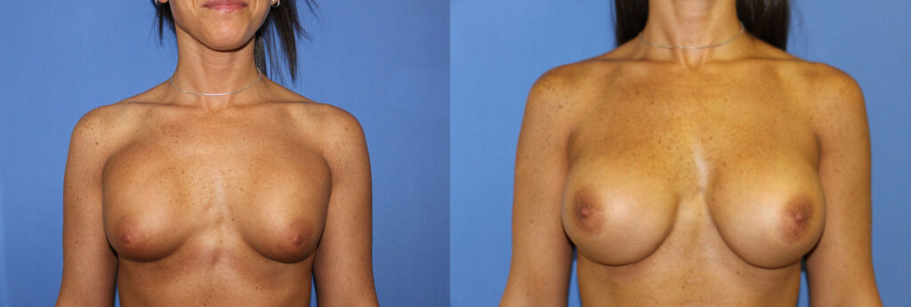 Breast Augmentation Before & After Photo. Breast Augmentation performed at Chau Plastic Surgery in Metro Detroit, MI.