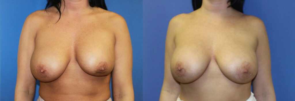 Breast Augmentation Before & After Photo. Breast Augmentation performed at Chau Plastic Surgery in Metro Detroit, MI.