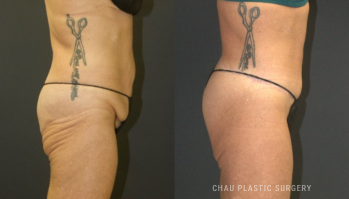 Tummy Tuck Before & After Photo. Tummy Tuck performed at Chau Plastic Surgery in Metro Detroit, MI