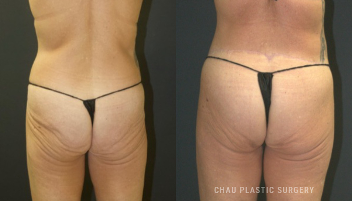 Tummy Tuck Before & After Photo. Tummy Tuck performed at Chau Plastic Surgery in Metro Detroit, MI